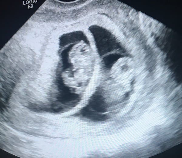 8 Week Sonogram