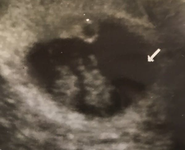 8 Week Sonogram
