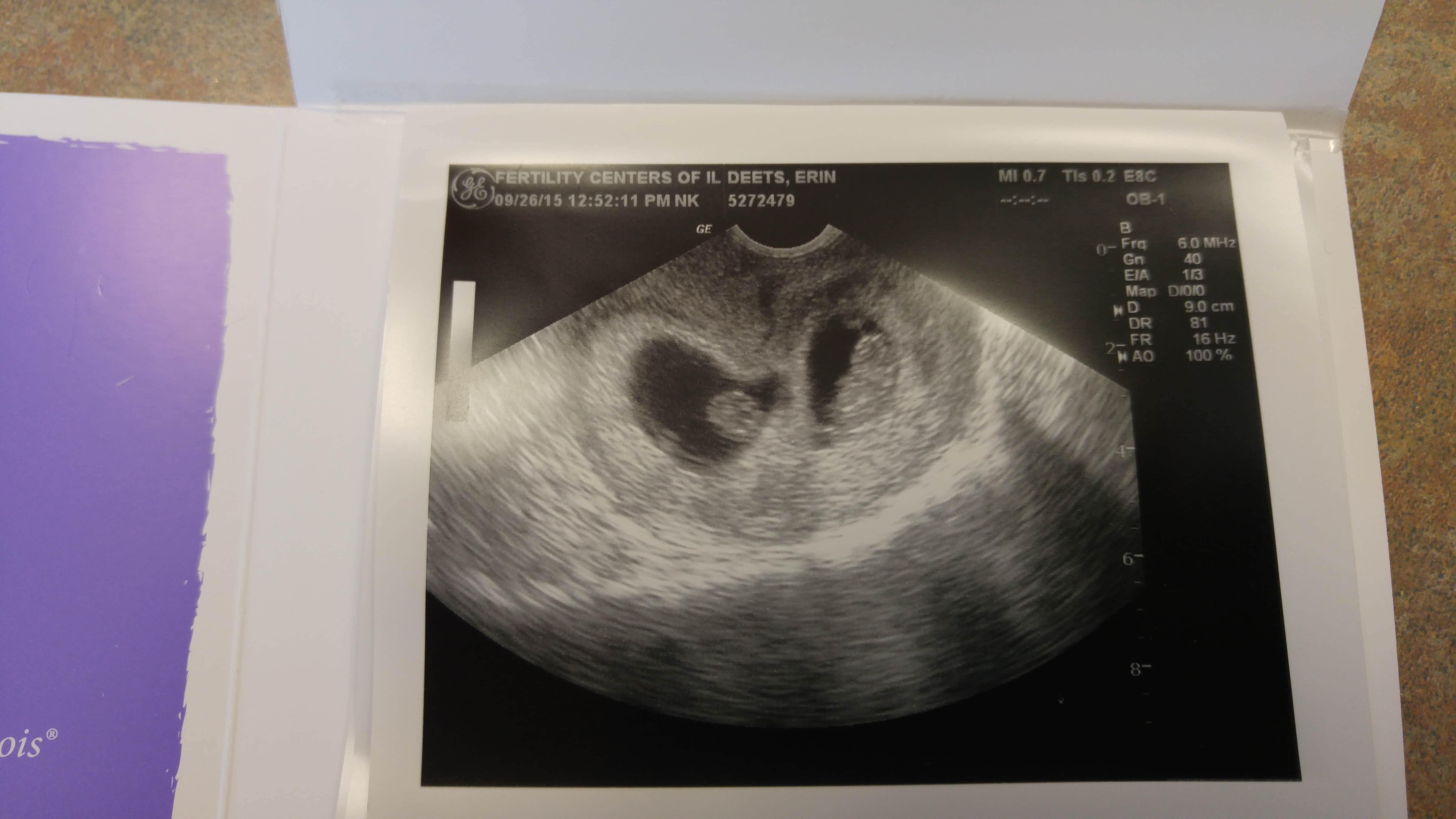 9 weeks pregnant with twins ultrasound