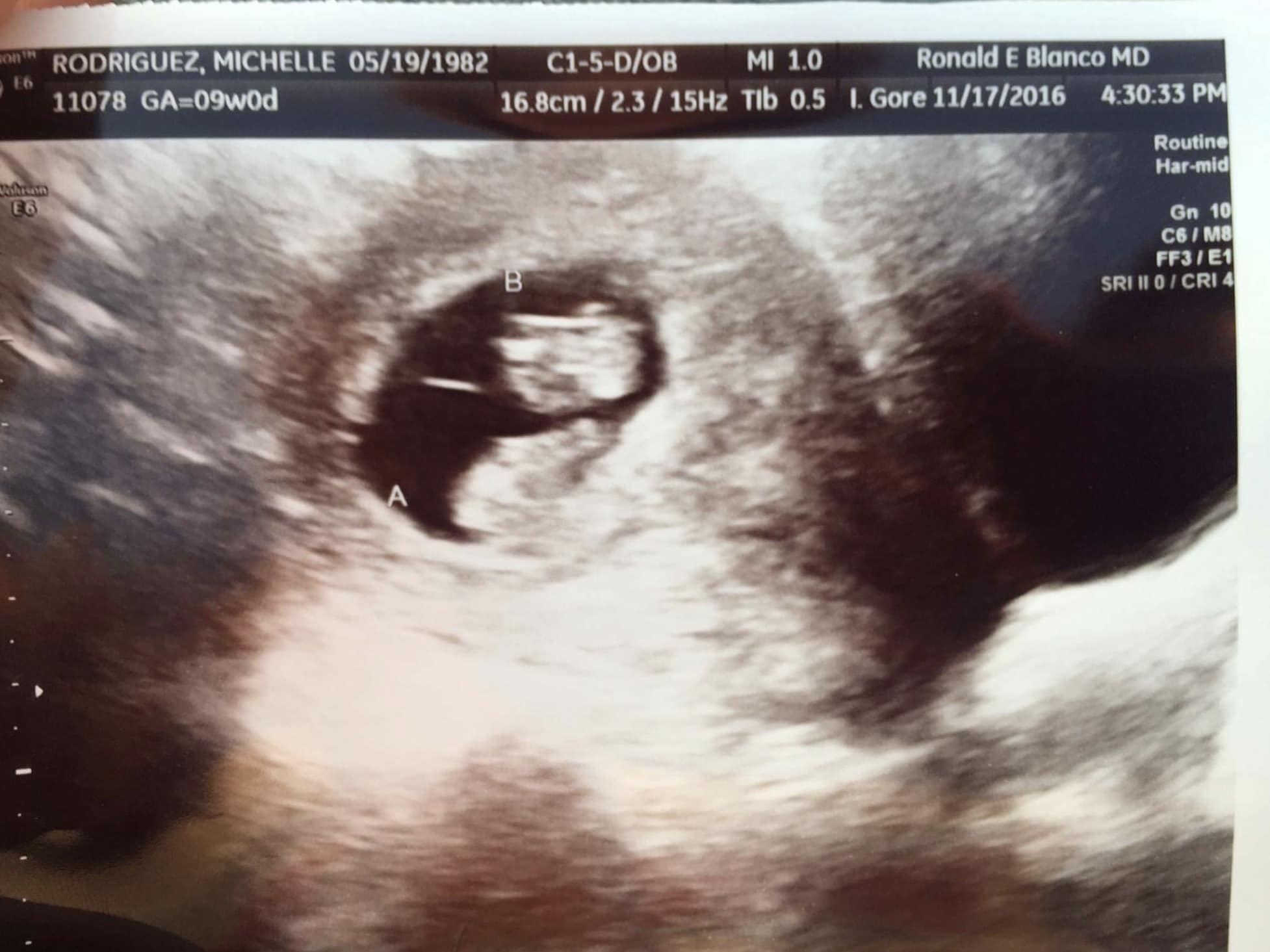 9 weeks pregnant with twins ultrasound