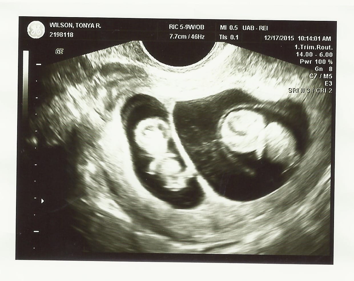 9 weeks pregnant with twins ultrasound