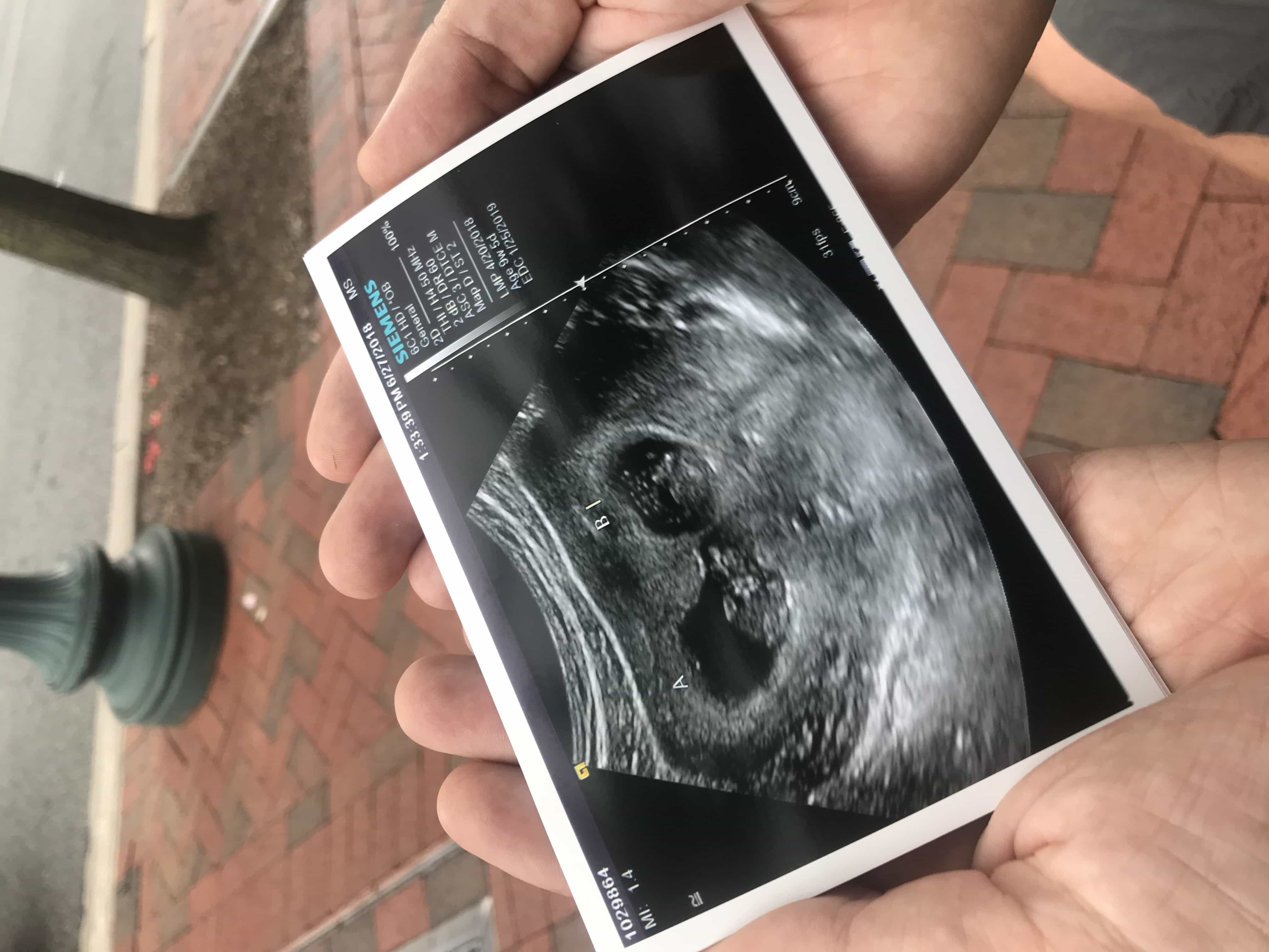 9 weeks pregnant with twins ultrasound