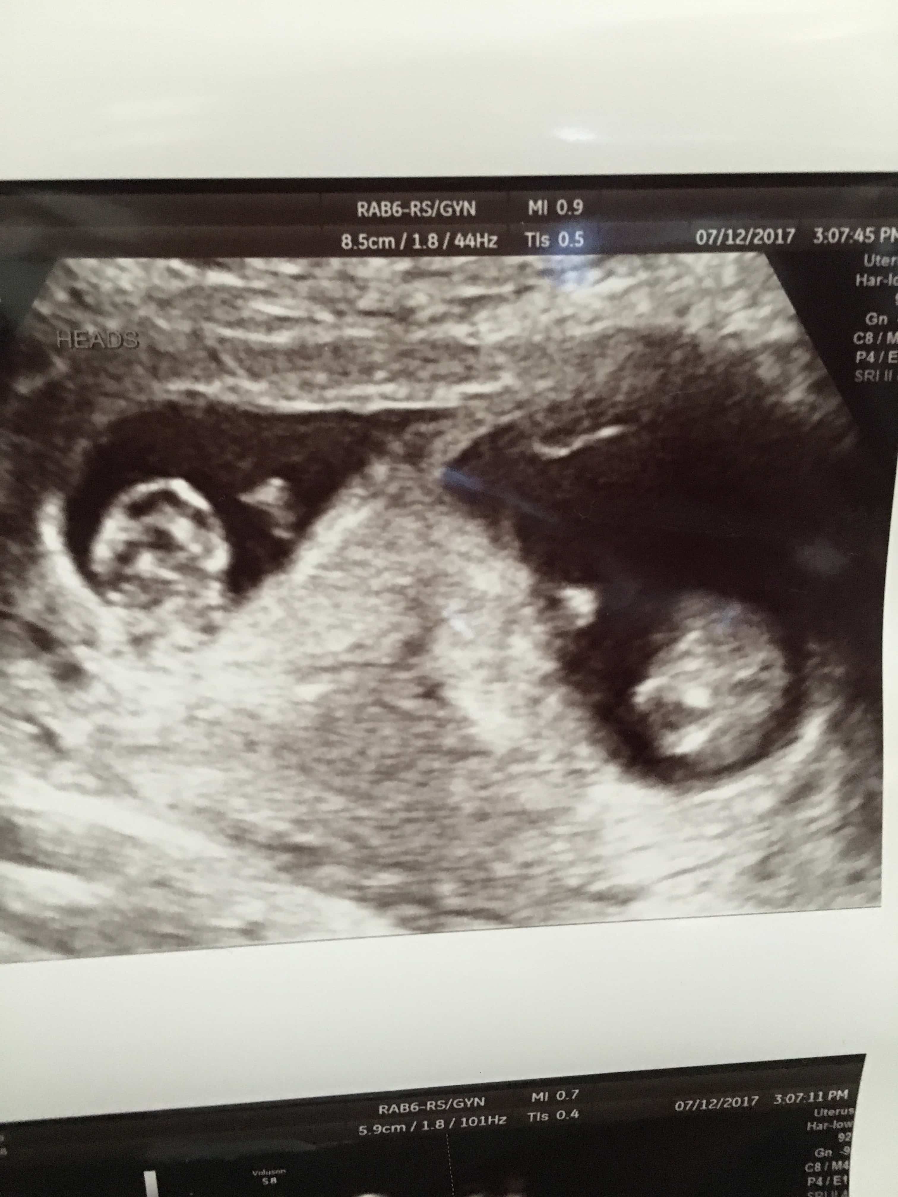 9 weeks pregnant with twins ultrasound