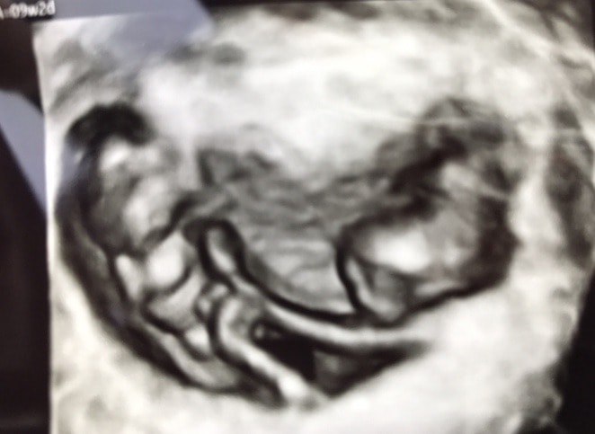 9 weeks pregnant with twins ultrasound