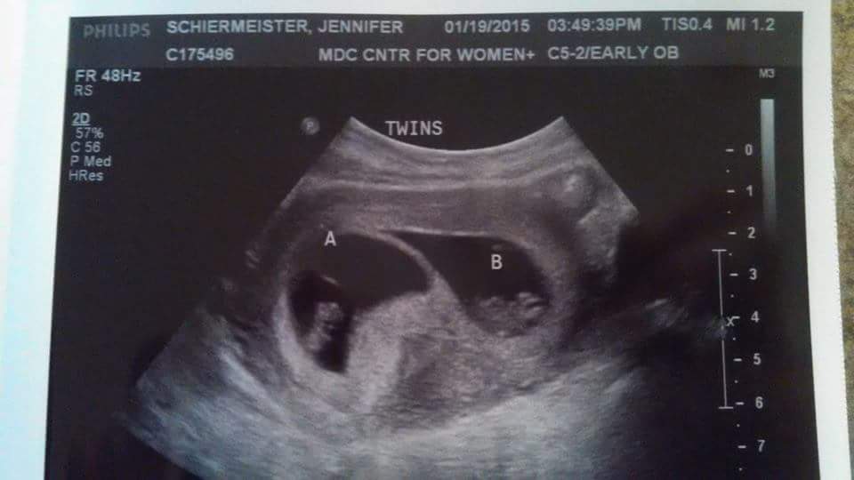 9 weeks pregnant with twins ultrasound