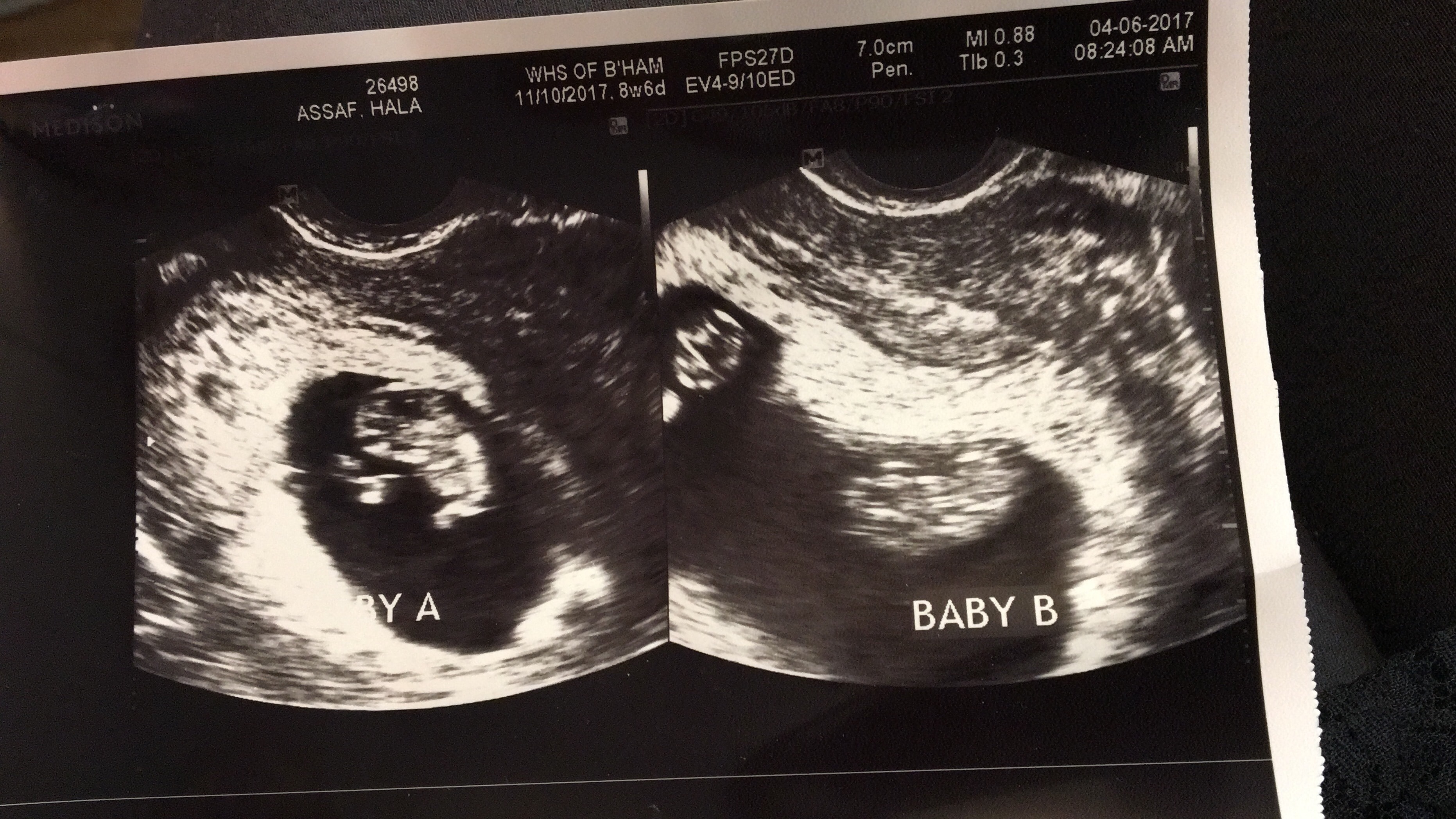 9 weeks pregnant with twins ultrasound