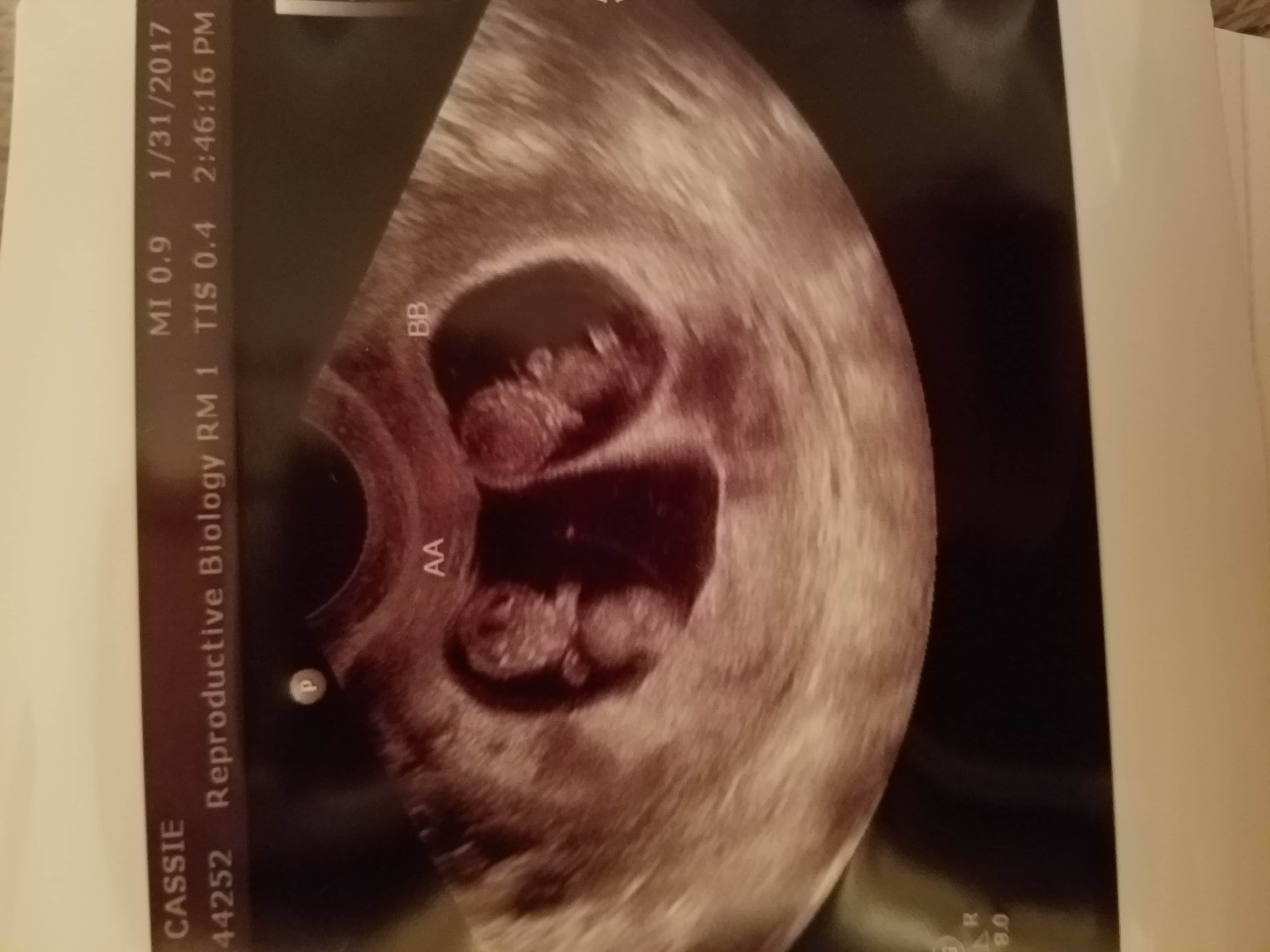 9 weeks pregnant with twins ultrasound