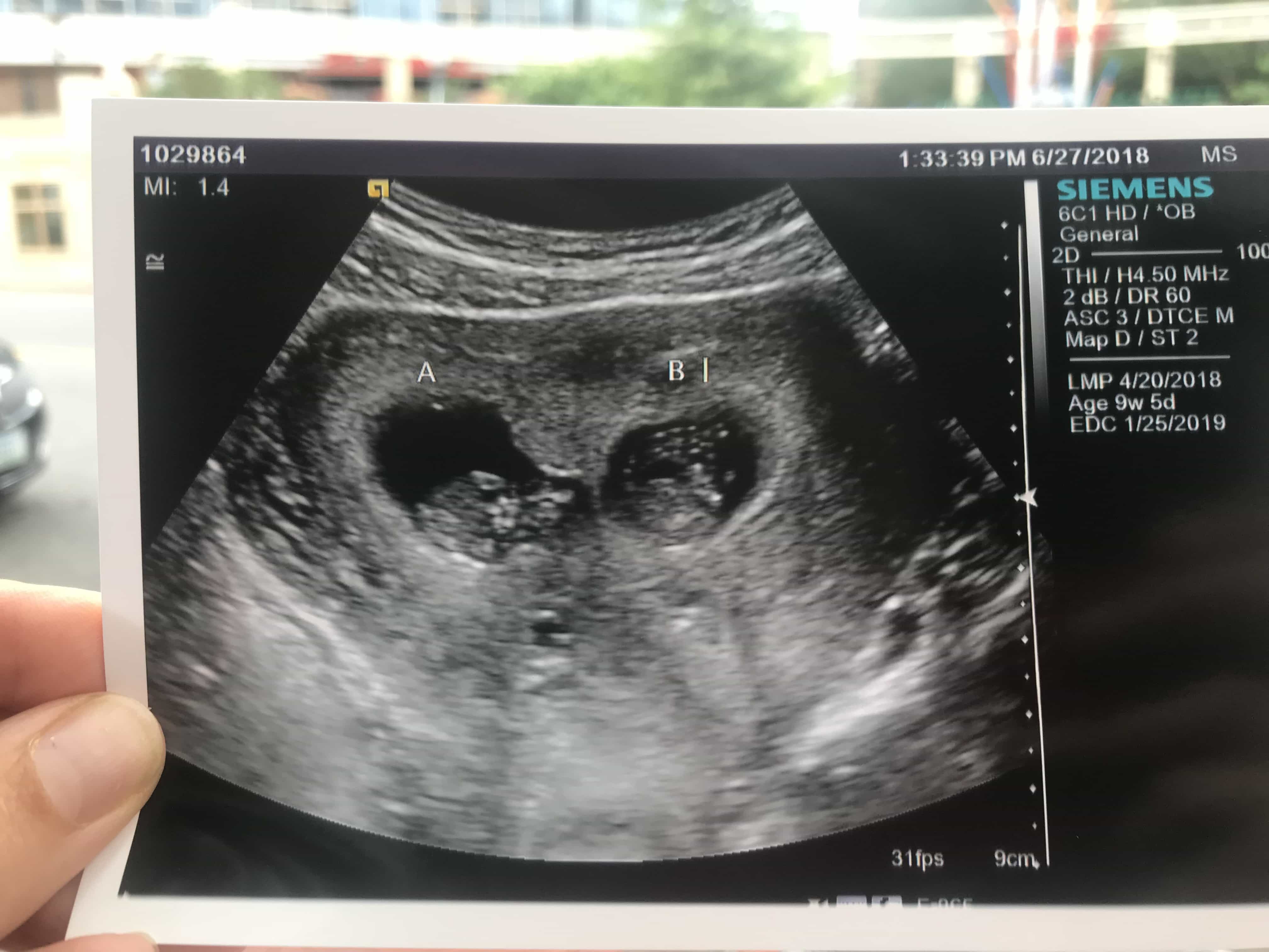 9 weeks pregnant with twins ultrasound