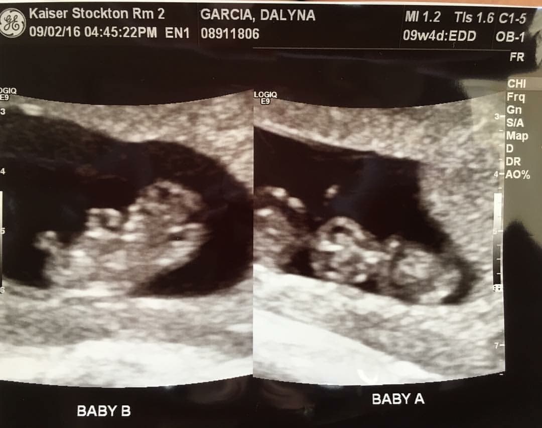 9 weeks pregnant with twins ultrasound