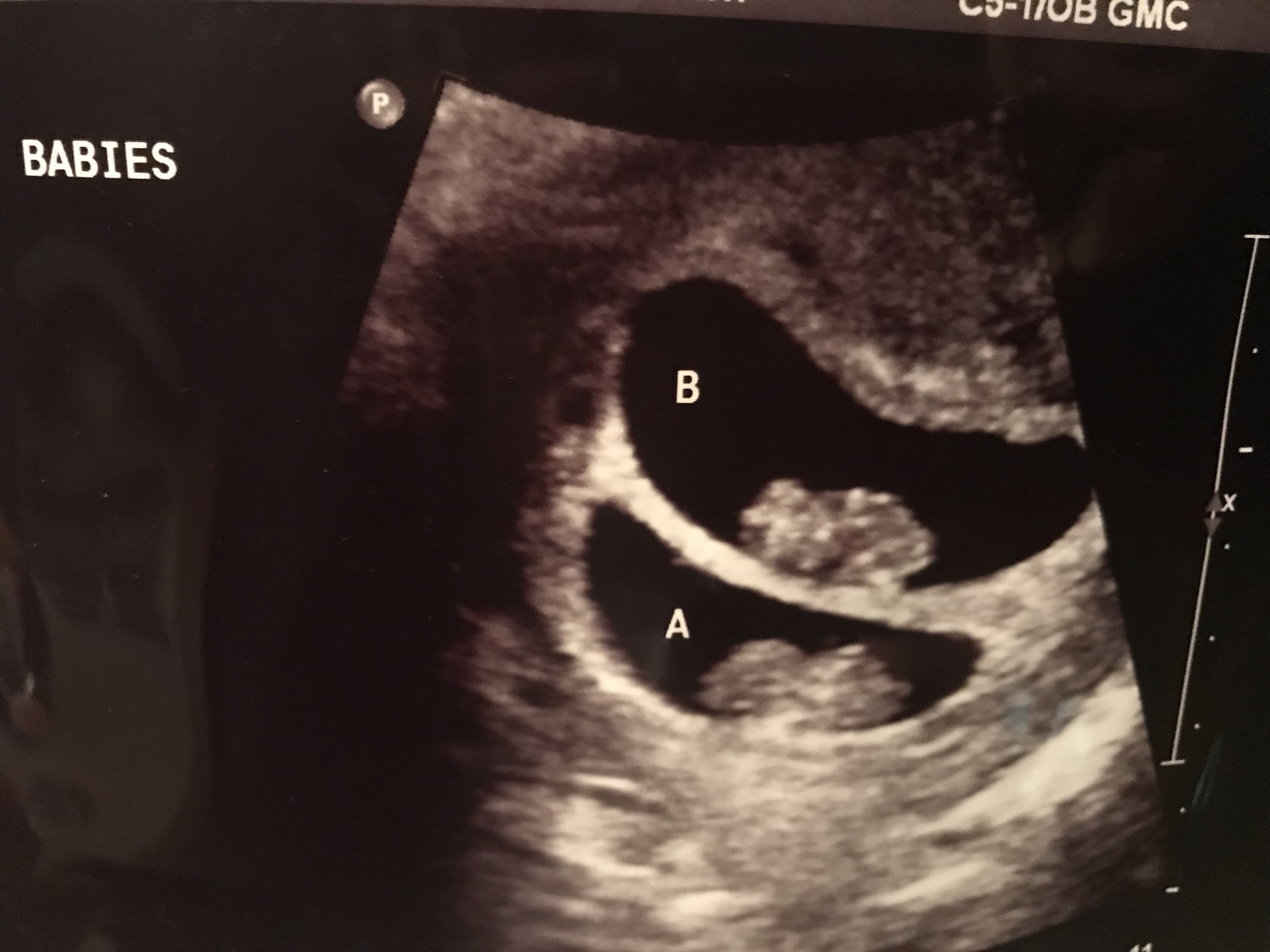 9 weeks pregnant with twins ultrasound