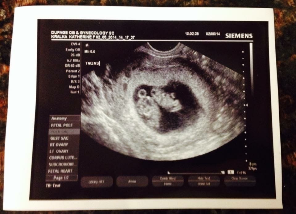 9 weeks pregnant with twins ultrasound