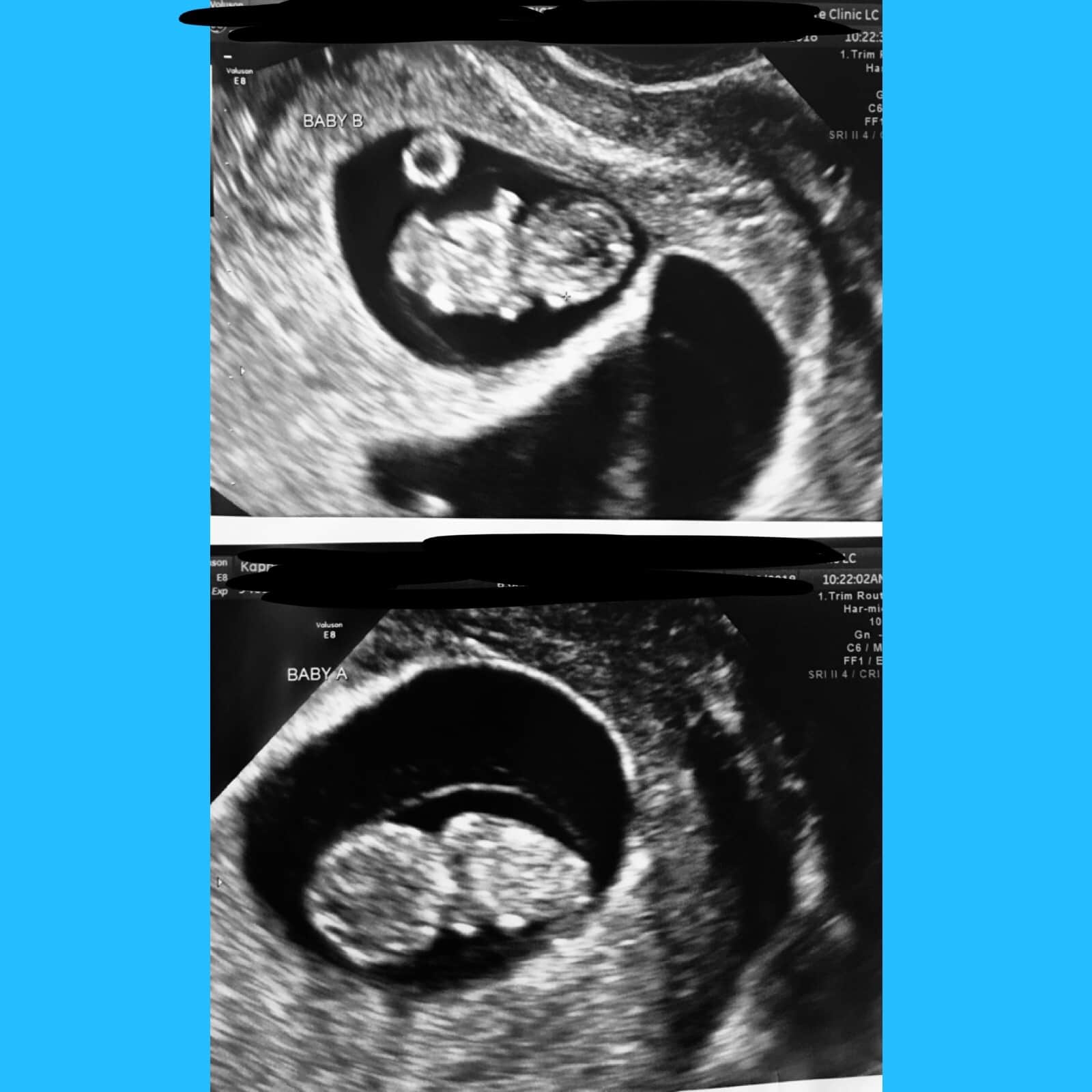 9 weeks pregnant with twins ultrasound