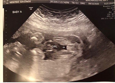 23 Weeks Pregnant With Twins Ultrasound