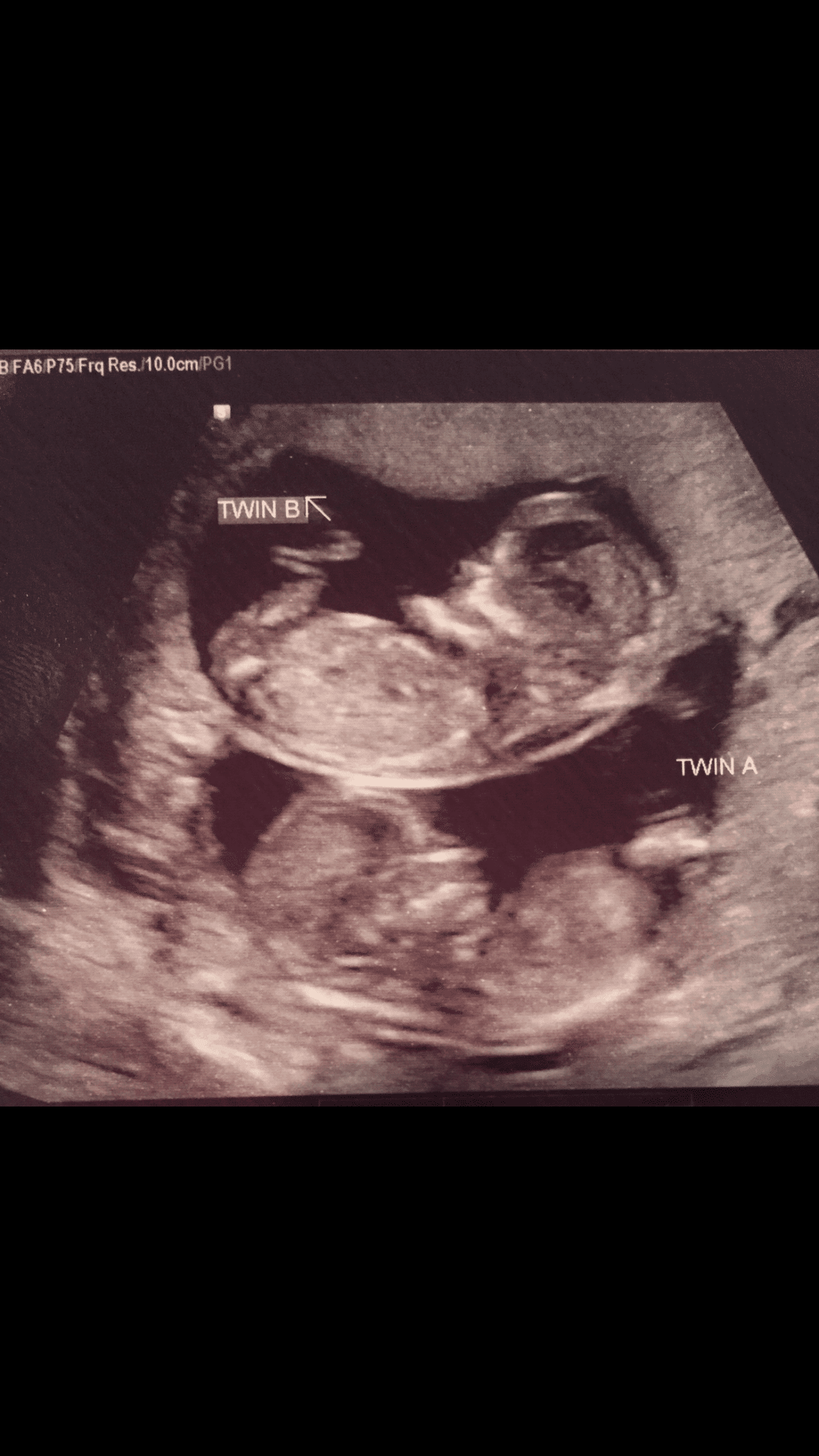 Ultrasound Photos at 12 Weeks Pregnant With Twins