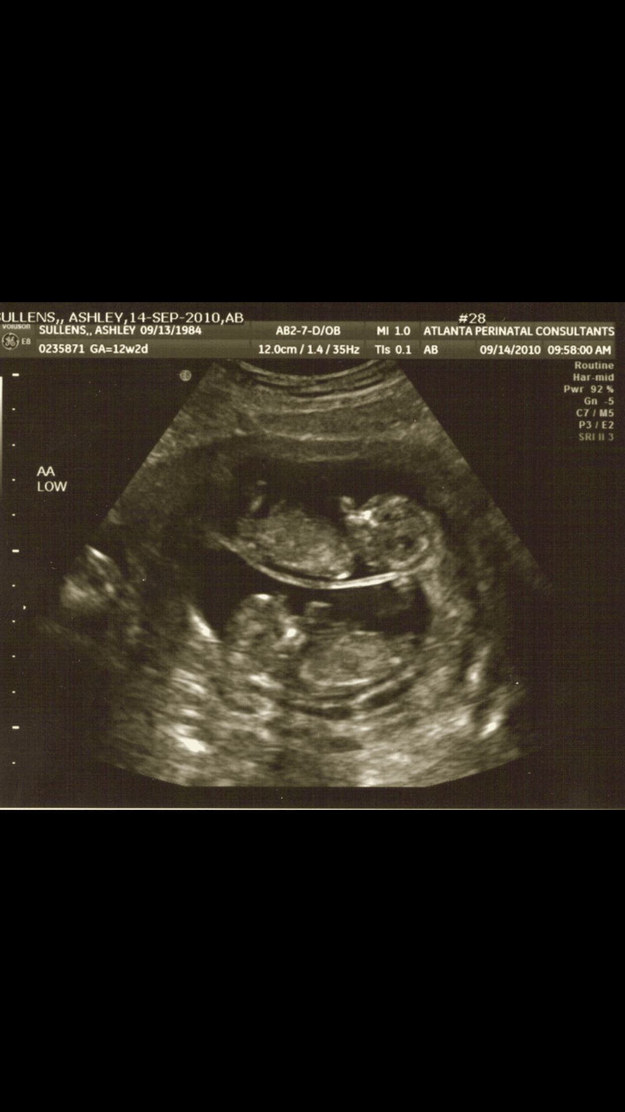 Ultrasound Photos at 12 Weeks Pregnant With Twins